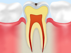 C0　削らずに治る場合もある、ごく初期の虫歯