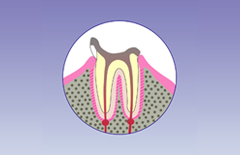 重度の虫歯でも根管治療で歯を残すことが大切です