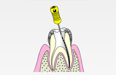 重度の虫歯でも根管治療で歯を残すことが大切です